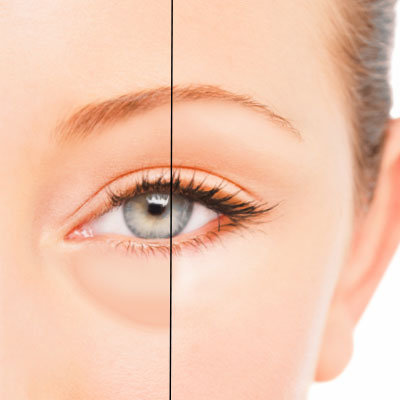 How to reduce under-eye bags